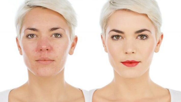 Makeup Tips For Rosacea Skin